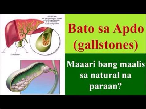 bato sa apdo pagtunaw sa natural na paraan|Namuong Bato sa Apdo o Gallstones — Narito ang Natural at .